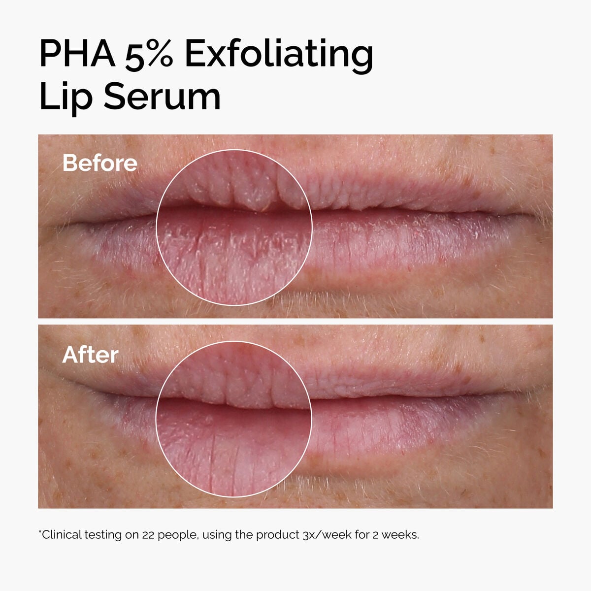 pha-5-exfoliating-lip-serum-u2 ord-pha-5pct-lip-exfoliating-serum-before-after.jpg