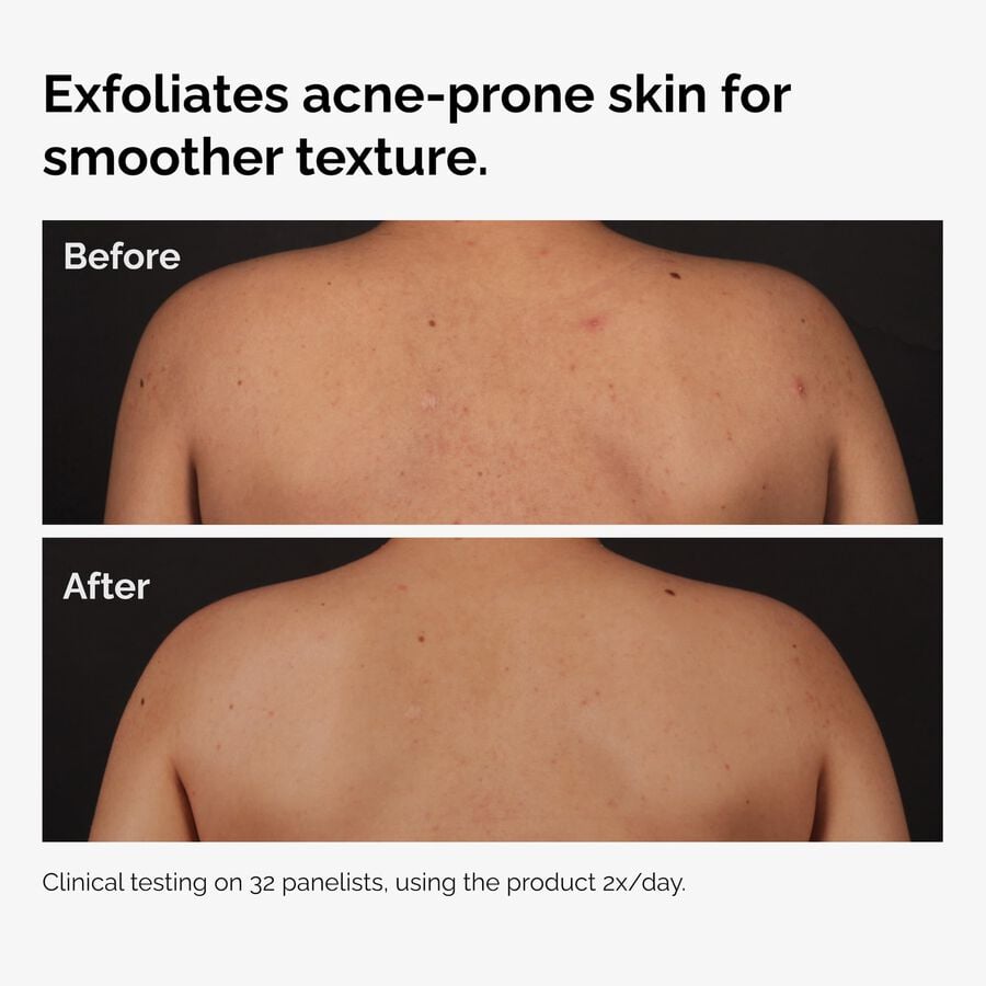 the-body-care-collection-p5 ord-salicylic-acid-body-serum-before-after-graphic-NA.jpg