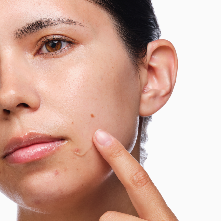 the-acne-set-v5 rdn-the-acne-set-application.png